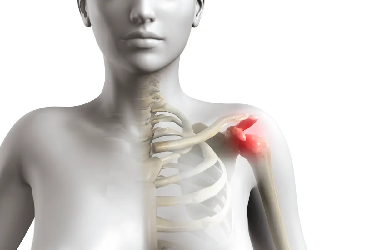 Recovery From A Shoulder Impingement