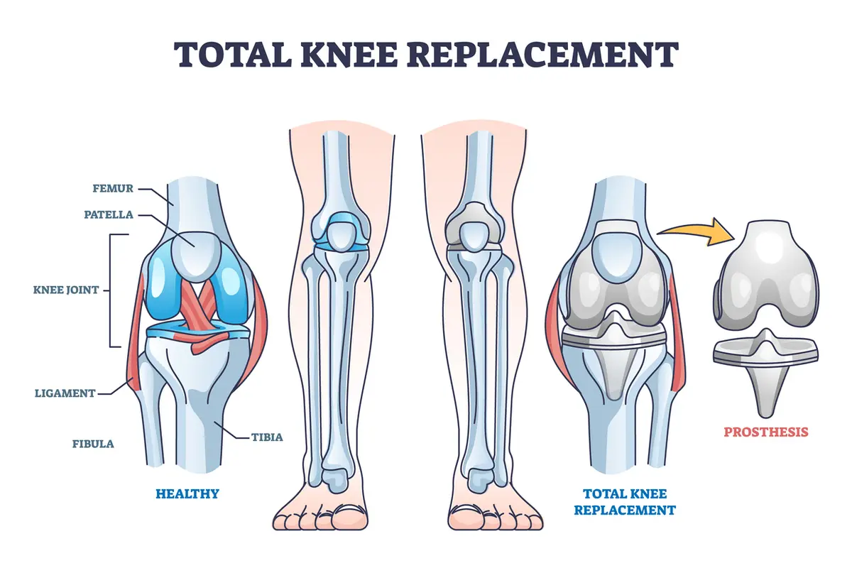 6 Tips for A Successful Outpatient Knee Surgery