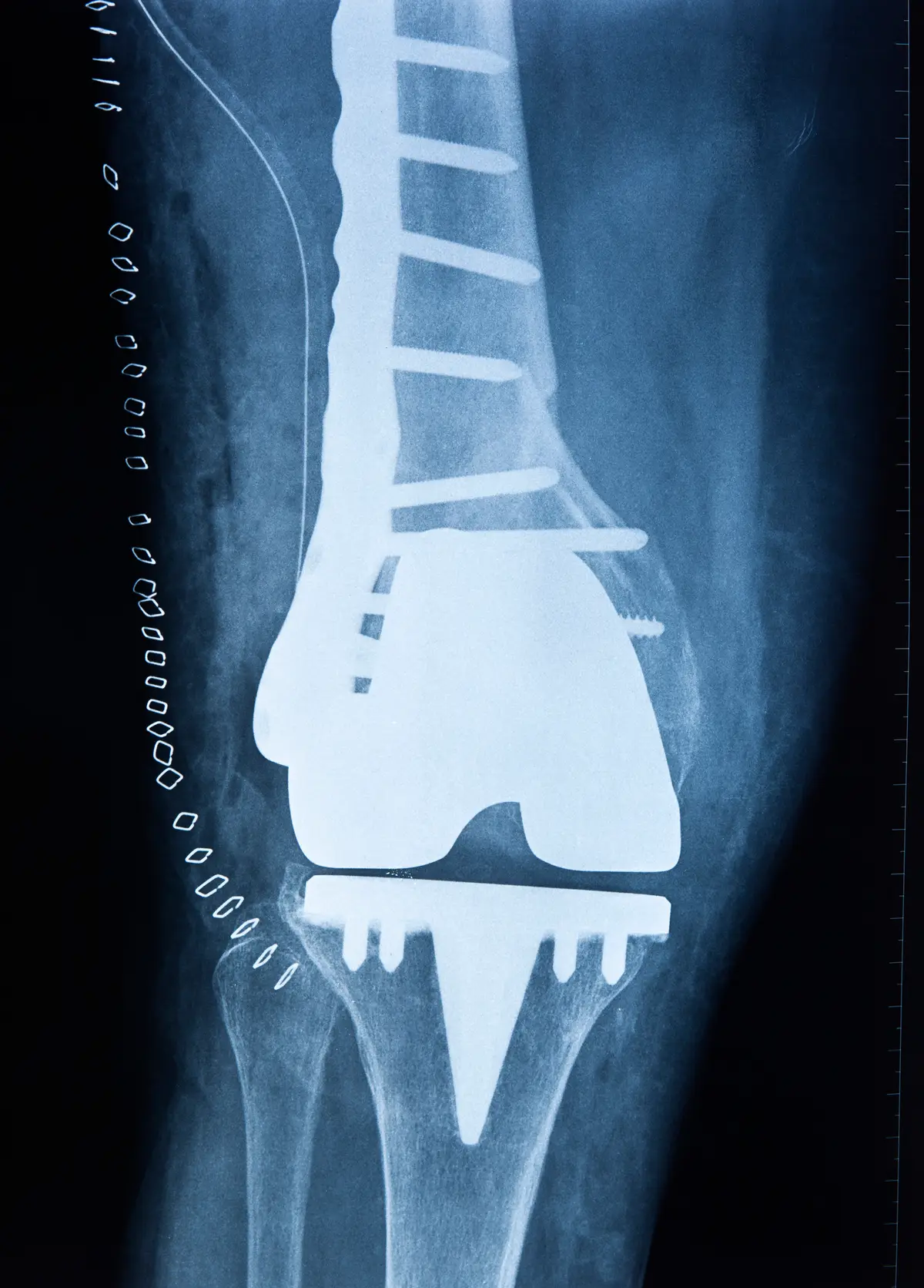 All About Total Joint Replacement Surgery