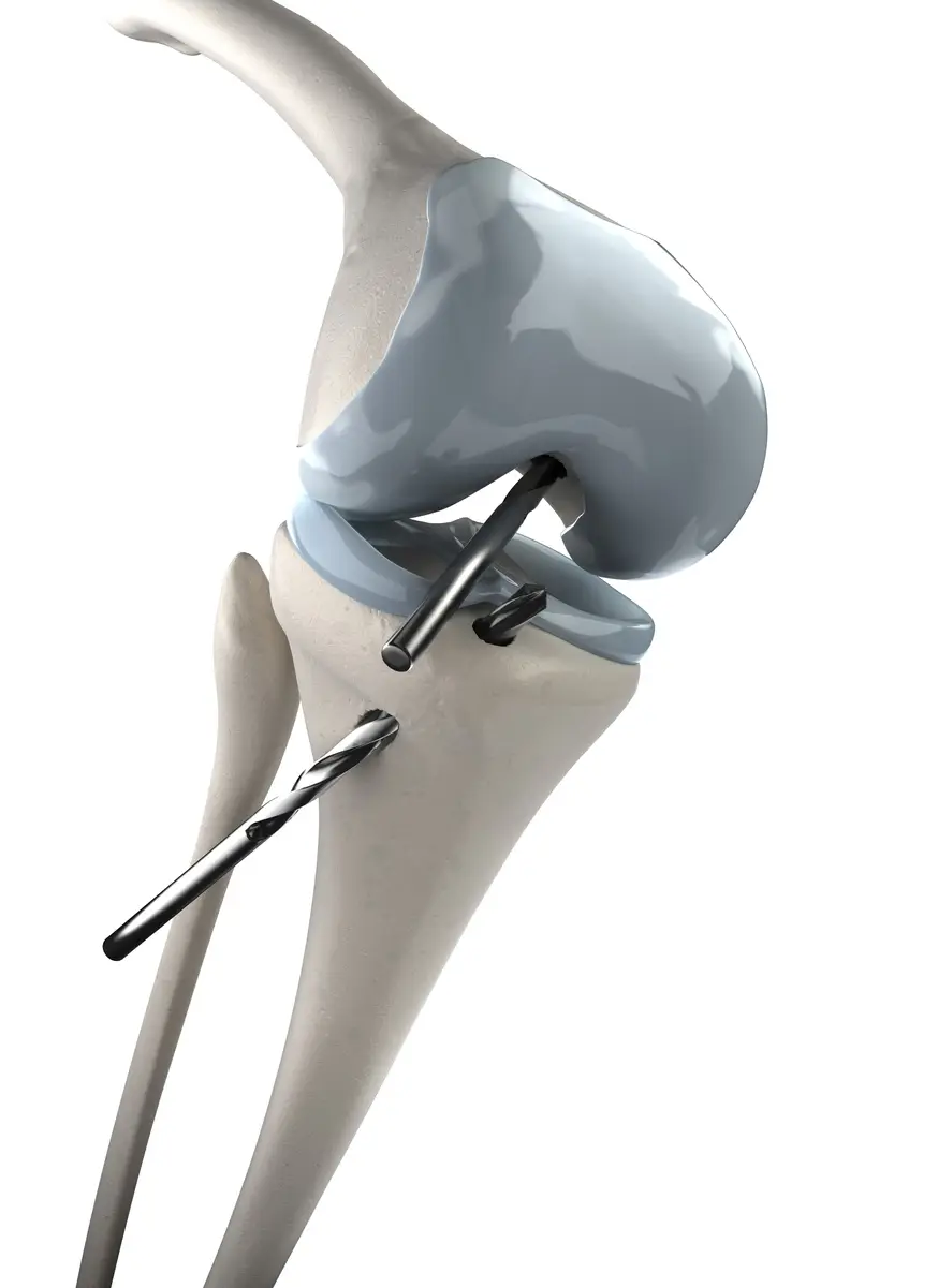 Arthroscopic Knee Surgery: Before, During, and After Surgery