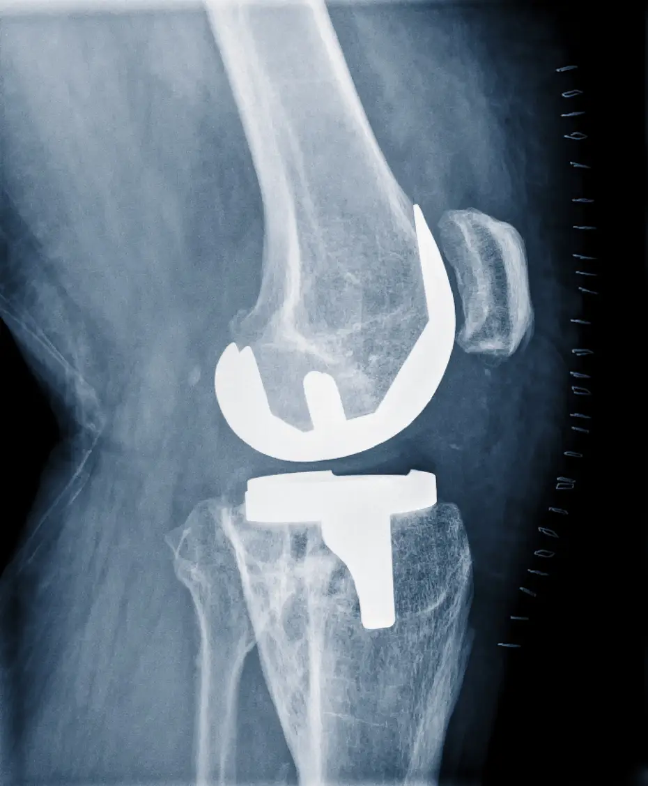 Custom Knee Replacement Surgery