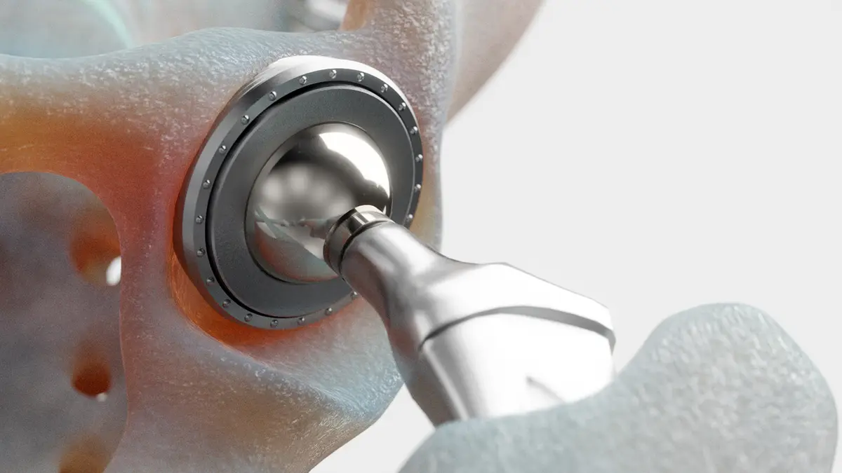 Exercises After A Hip Replacement