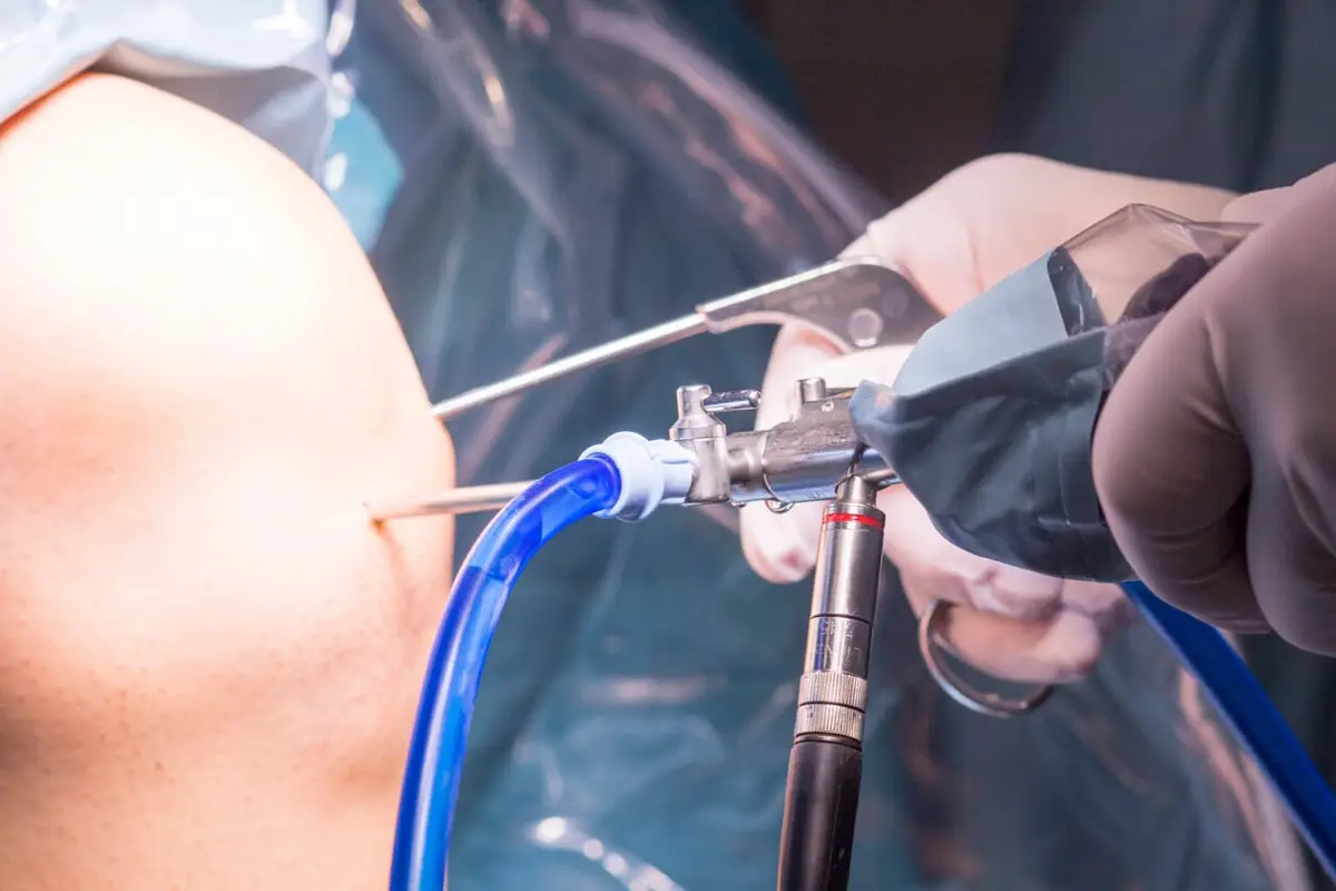 Knee Arthroscopy: Understanding the Minimally Invasive Procedure