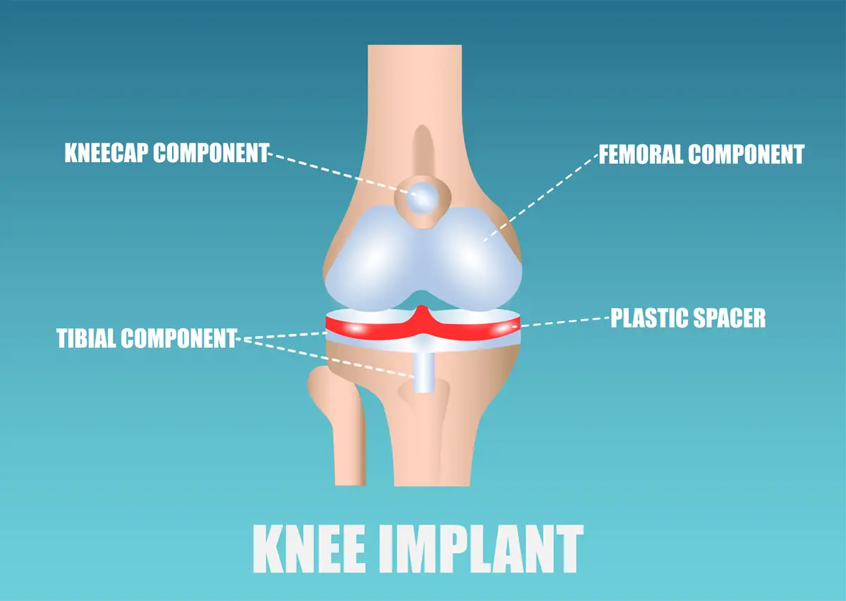Types of Knee Replacement Implants