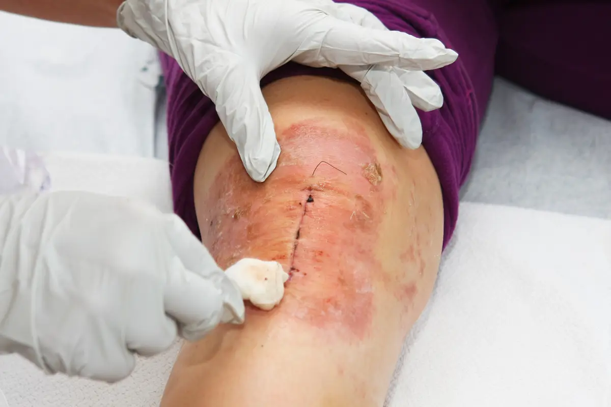 Why Do I Need Knee Arthroscopy?