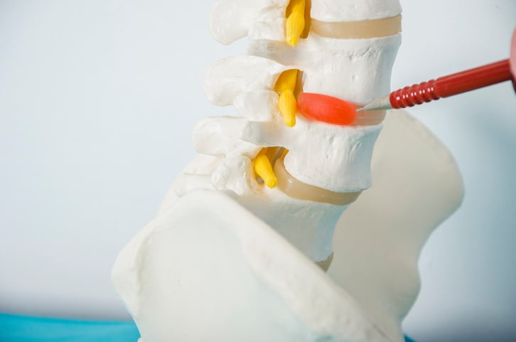 The Difference Between a Herniated Disc and a Bulging Disc