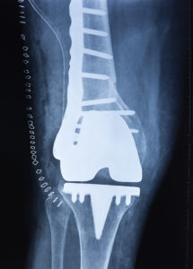 Total Joint Replacement Surgery