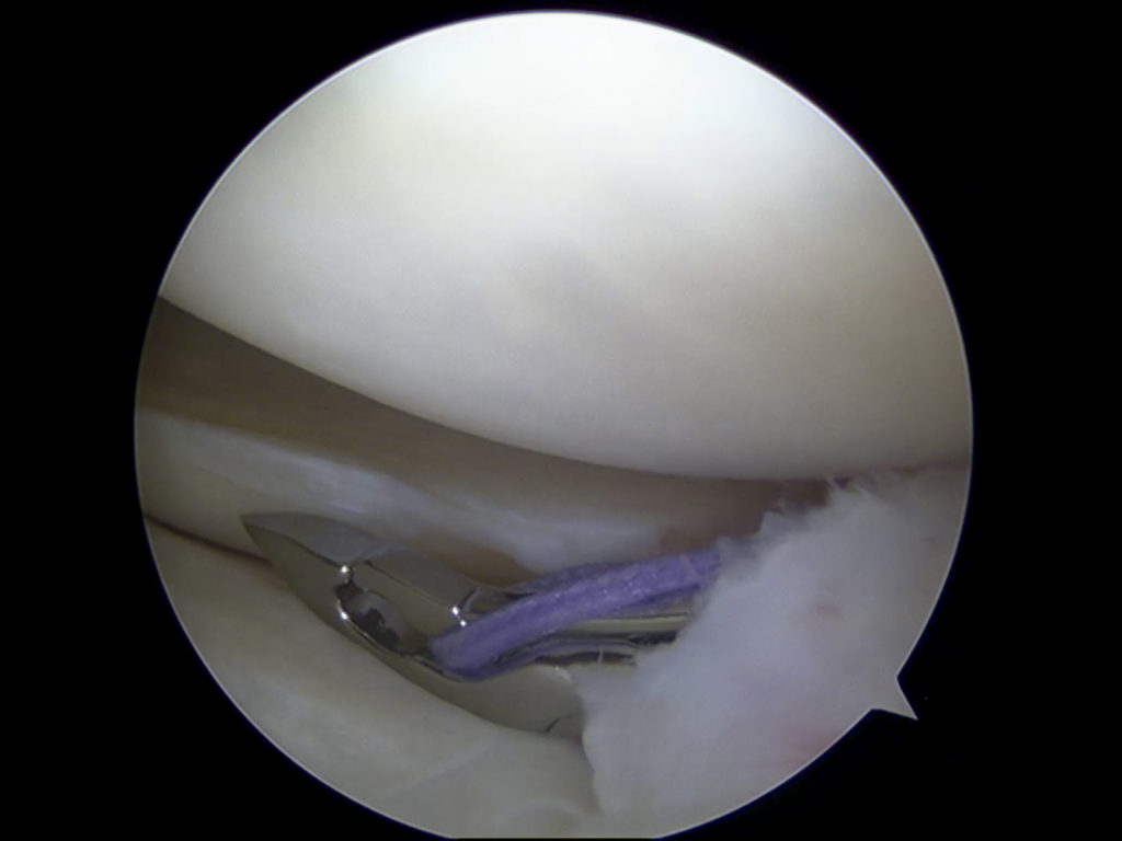 Meniscus tears