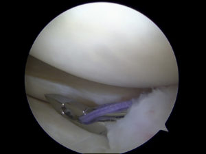 Meniscus tears