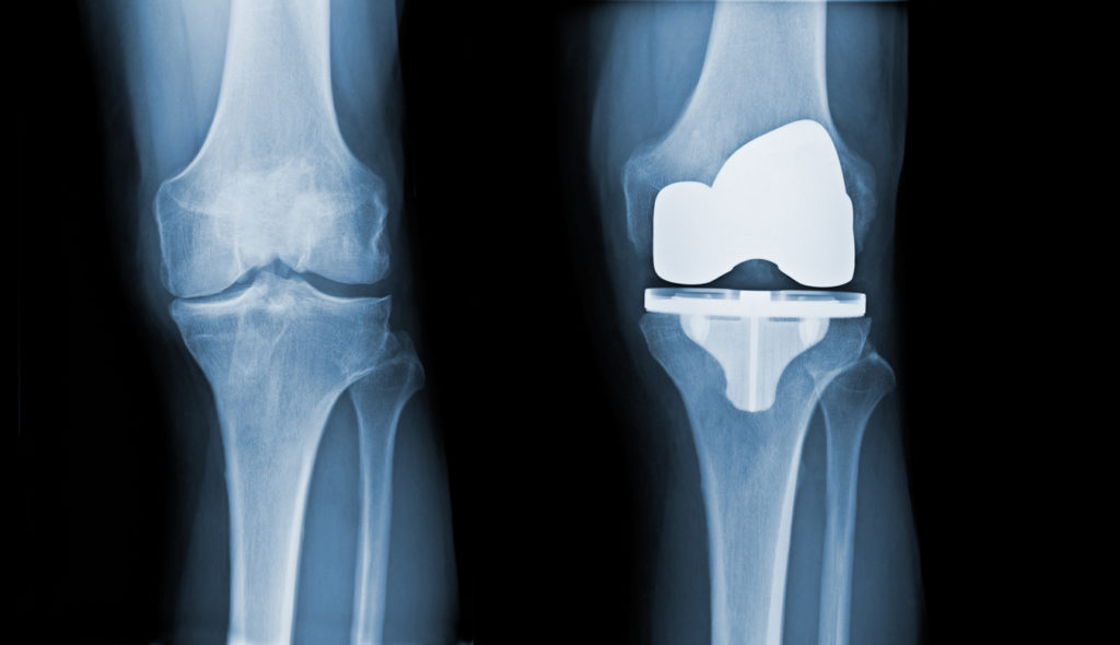 Total Knee Replacement X-ray
