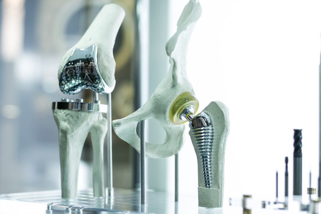 A prosthetic knee that will be used in a patient's knee replacement surgery.