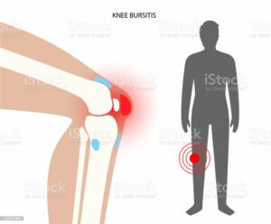 Knee injury treatment of a patient