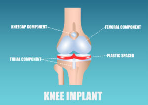 Vector of a knee implant