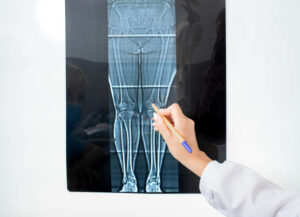 X-ray of knee joint on a negatoscope, X-ray as a type of diagnosis for the treatment of diseases and injuries of the joints of the legs
