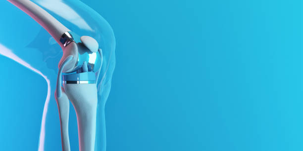 x-ray show knee joint replacement