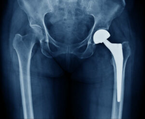 X-ray scan image of hip joints with orthopedic hip joint replacement implant head and screws in human skeleton in blue gray tones. Scanned in orthopedics traumatology surgery hospital clinic.