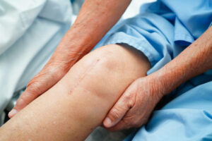Asian elderly woman patient with scar knee replacement surgery in hospital.