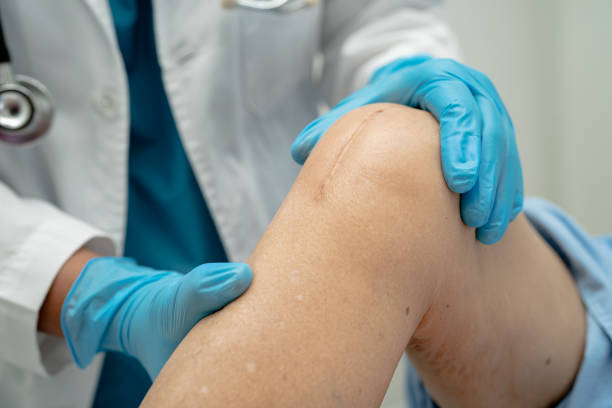 Doctor check Asian senior or elderly old lady woman patient scars surgical total knee joint replacement Suture wound surgery arthroplasty in hospital ward, healthy strong medical concept.