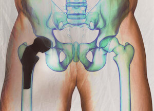 hip replaent x-ray prior to revision surgery