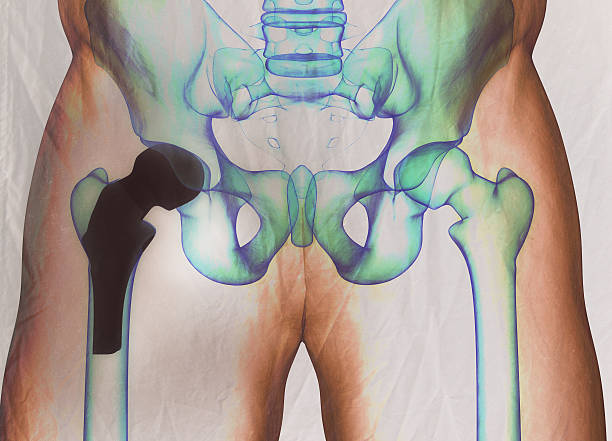 hip replaent x-ray prior to revision surgery
