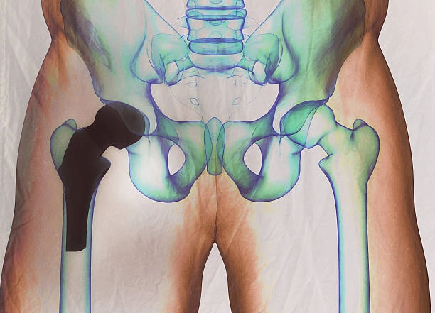 hip replaent x-ray prior to revision surgery