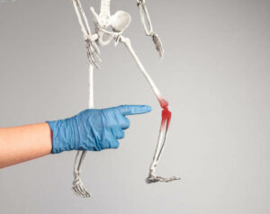 after meniscus tear treatment