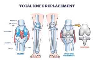 Total knee replacement surgery and prosthesis operation outline diagram