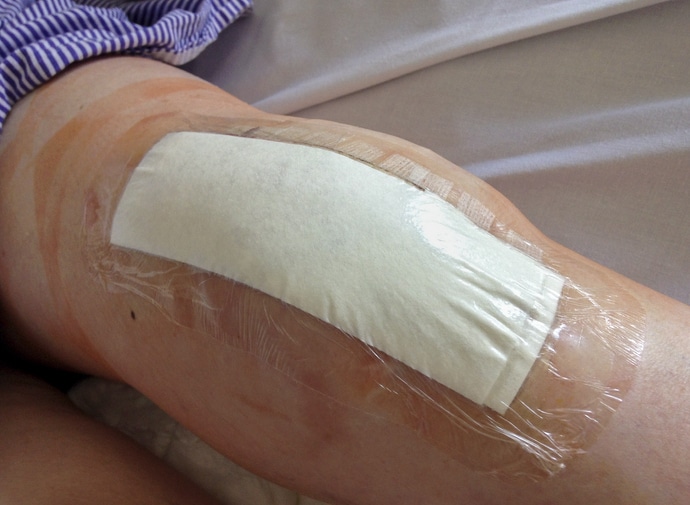 Senior woman's knee after knee revision surgery