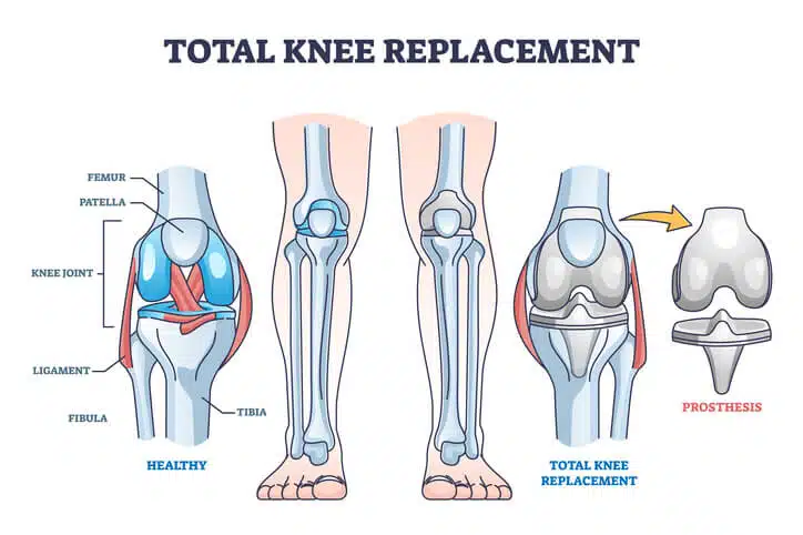 Total knee replacement surgery and prosthesis operation outline diagram