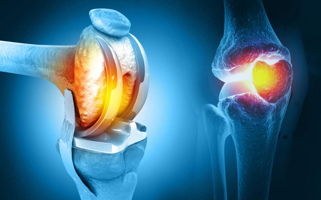 knee replacement surgery