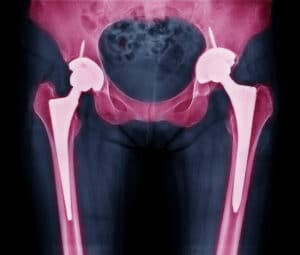 Image of X-ray scan for total hip replacement due to osteoarthritis, featuring an artificial hip joint and related hip pain.