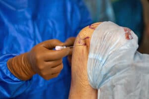 Knee Replacement Surgeon Is Operating on a Patient.