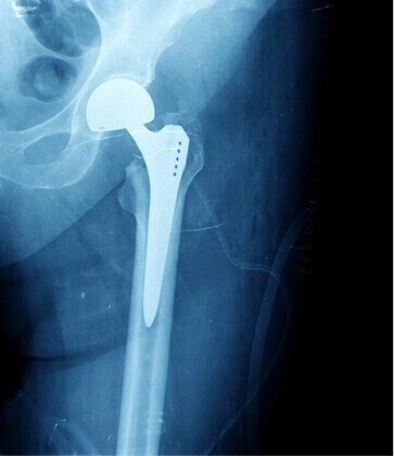 Joint replacement surgery for Joint Like Hip,Knee