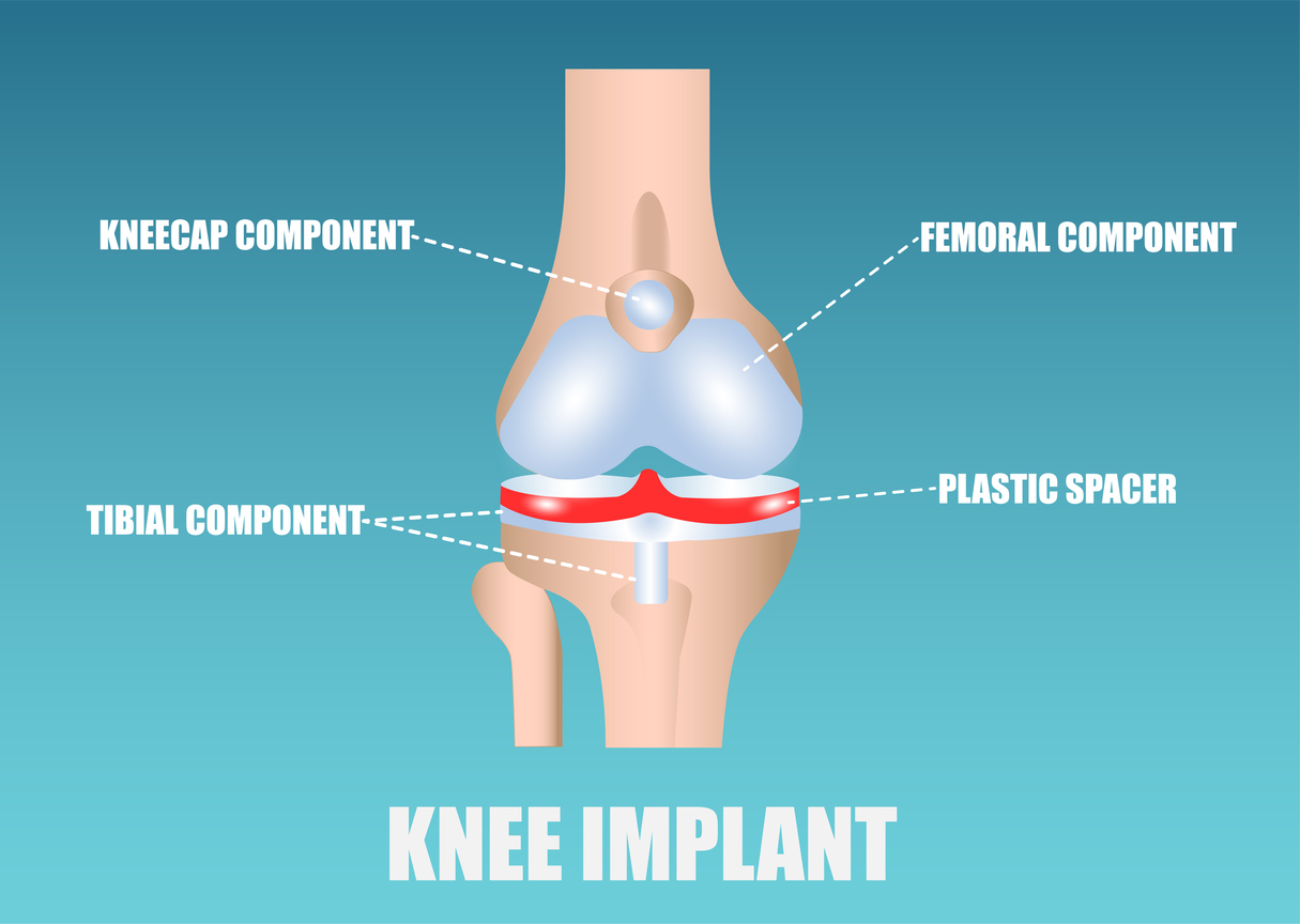 Parts and Materials for Knee Replacements